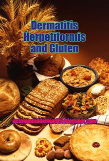 Dermatitis Herpetiformis and Gluten