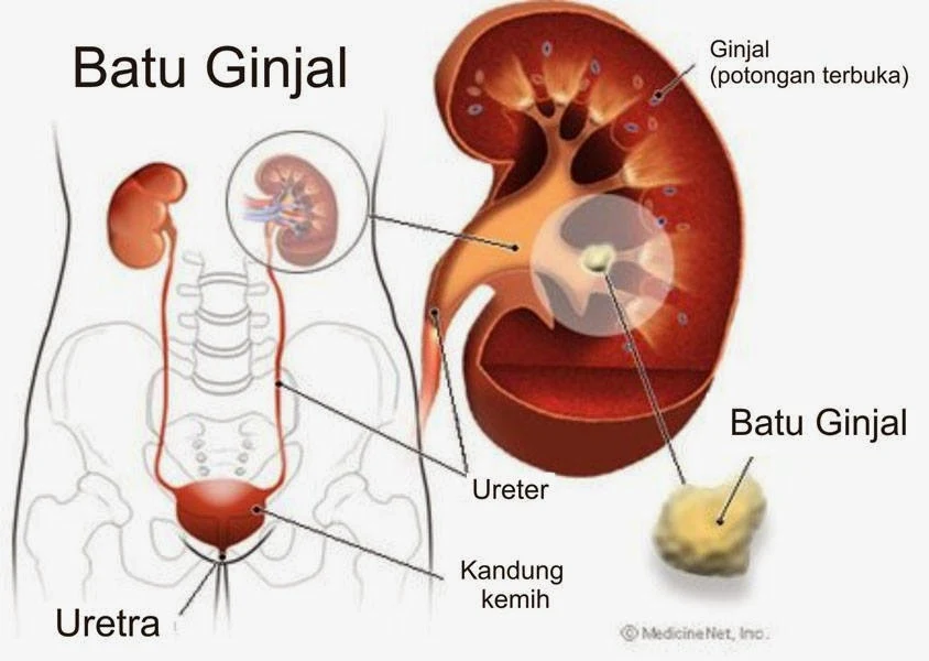 Gejala Penyakit Batu Ginjal, Penyebab dan Metode Penanganan Pengobatan Batu Ginjal 