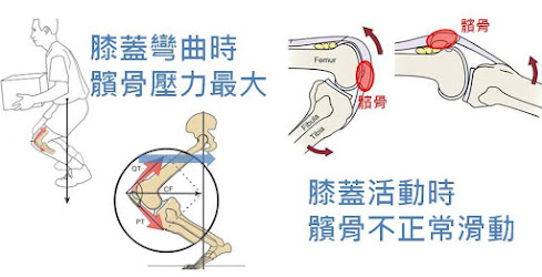 #髕骨股骨疼痛症候群 #髕骨外翻 # 髕骨軟化 #跑者膝 #復健運動 #治療 #李嘉瑋醫師