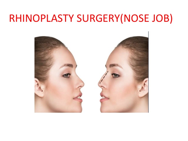 Rhinoplasty in Hyderabad