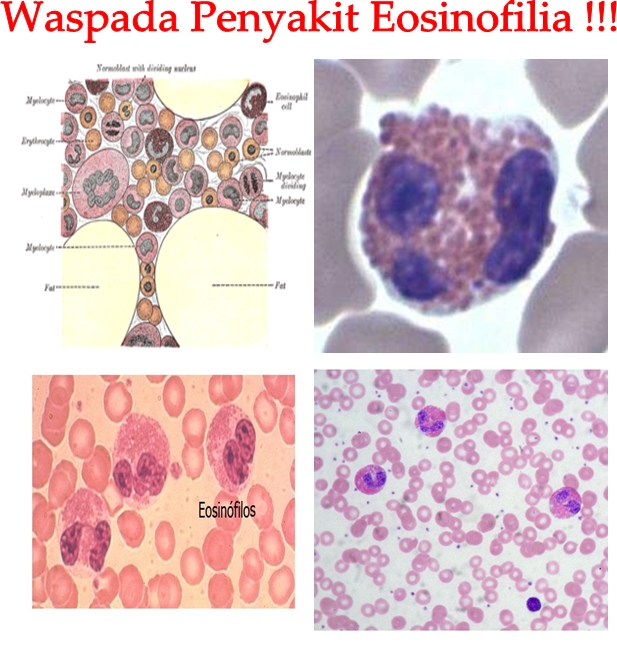 Obat Tradisional Eosinofilia