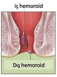 iç hemoroid dış hemoroid