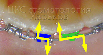 Брекеты Ланга лучше вращают зубы