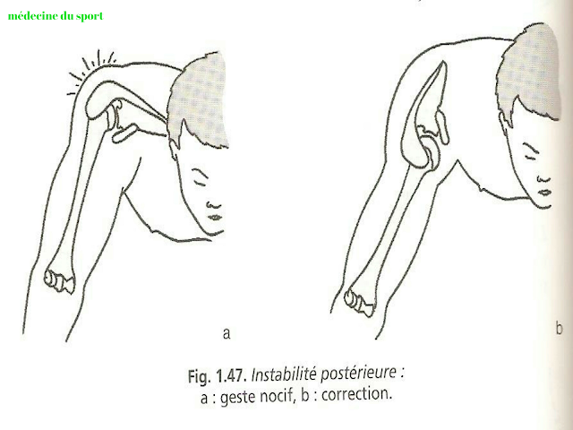 Les Luxations de l’épaule