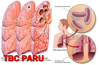 Penyakit Paru Paru