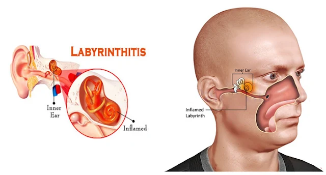 Labyrinthitis