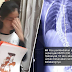 Anak hidap scoliosis, perlukan dana RM40K untuk operation luruskan tulang belakang