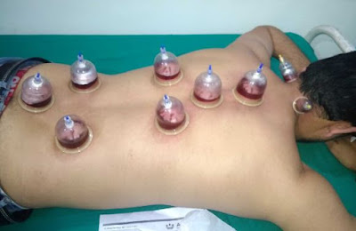 Hijama in Islam