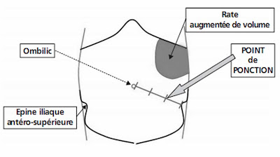 cours infirmier ponction ascite technique soin localisation