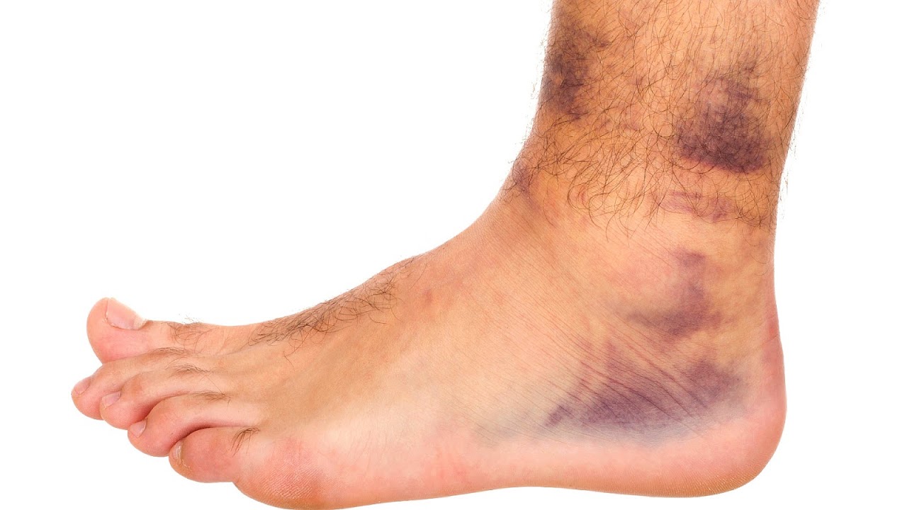 Bruise - Contusion Injury