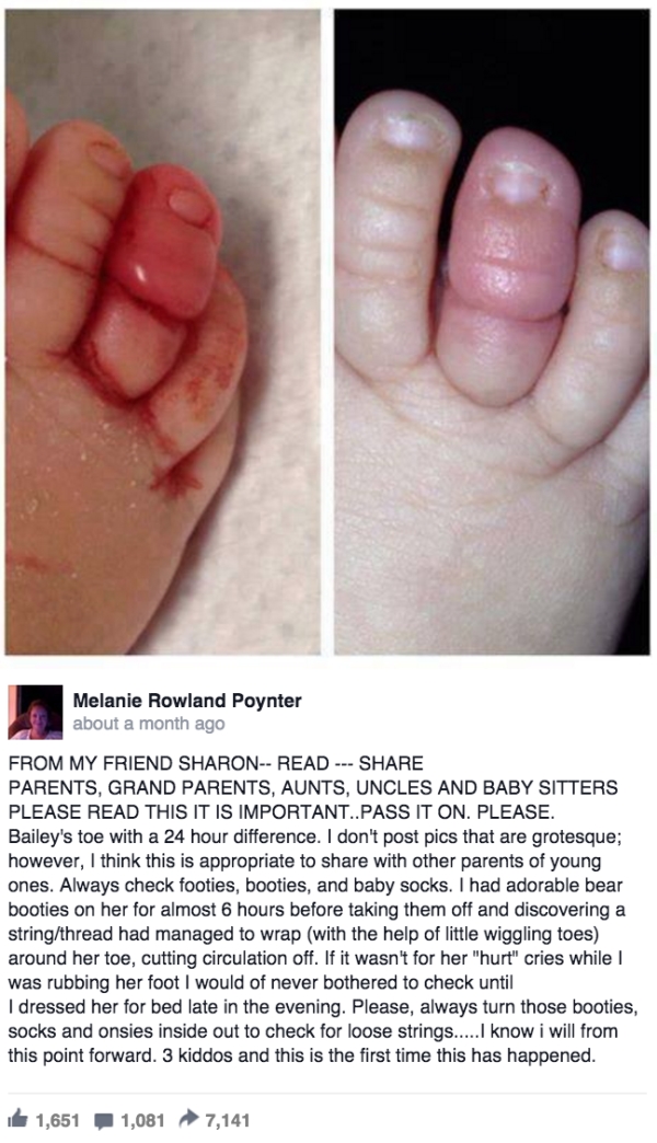 Dad Shares Photos Of His Babys Toe To Warn Others Of This Danger