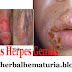 Obat Herbal Penyakit Herpes Genitalis Ampuh
