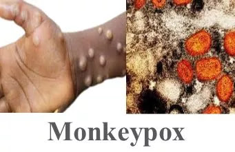 Monkeypox