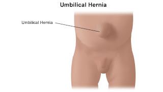 Hernia+Umbilikal