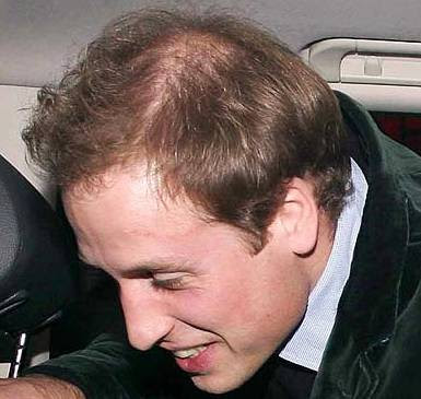 is prince william going bald prince william & kate. WILLIAM - THE PRINCE CLEARLY