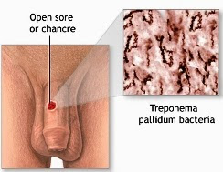 Syphilitic Chancre