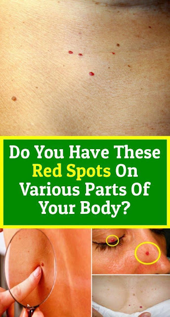 Do You Have These Red Spots On Various Parts Of Your Body!!!