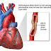 Obat penyakit Jantung Koroner