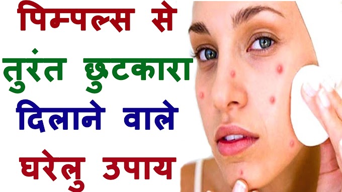 पिंपल/मुंहासे का इलाज इन 8 चीजों से छूमंतर हो जाएंगे ...How to get rid of pimples 