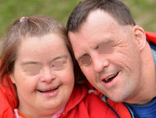 A photo of adult patients with Hurler syndrome picture