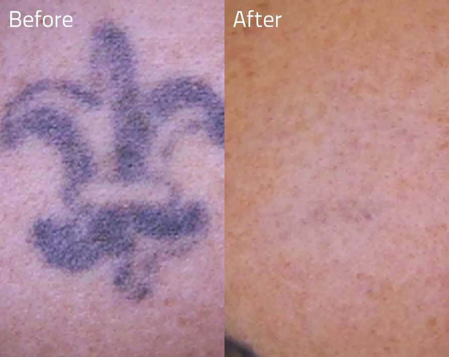 Before_And_After_Tattoo_Removal_Erase_Tattoo_Removal.jpg
