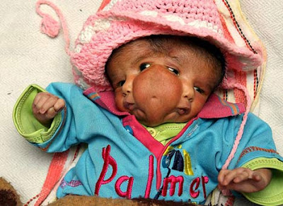 Two-Faced Baby Born in India