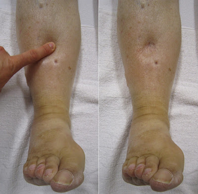 What causes swelling in the legs,swelling in legs causes,swelling in legs treatment