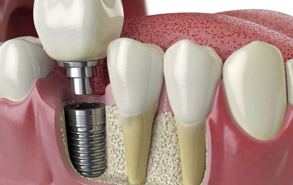 Dental Implants