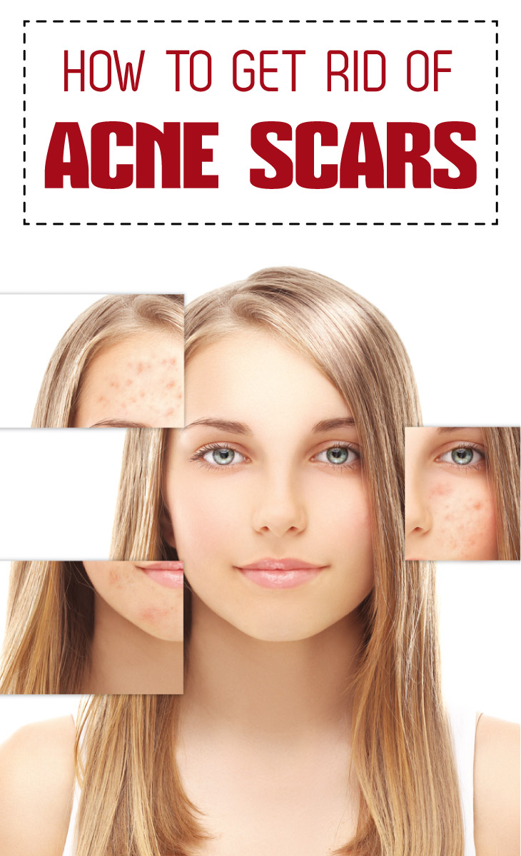 How to Get Rid of Acne Scars Cute Parents