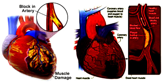 Heart attack: Causes, Symptoms, Prevention and Treatment.