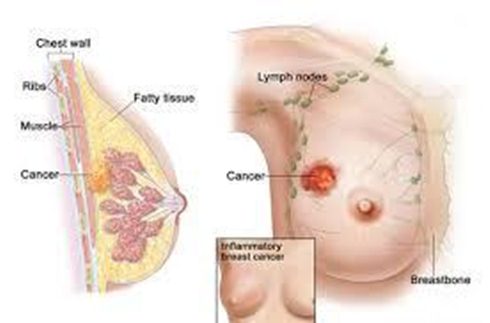 Kanker payudara apa menular, herbal kanker payudara, kanker payudara dan ciri-cirinya, terapi kanker payudara stadium 3, tumbuhan untuk menyembuhkan kanker payudara, kanker payudara keluar nanah, kanker payudara genetik, obat alami untuk mengobati kanker payudara, pengobatan kanker payudara dengan radiasi, obat alami gejala kanker payudara, obat kanker payudara pada ibu hamil