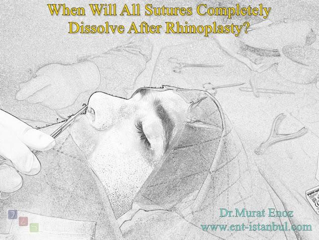 The Time For Rhinoplasty Stitches To Dissolve
