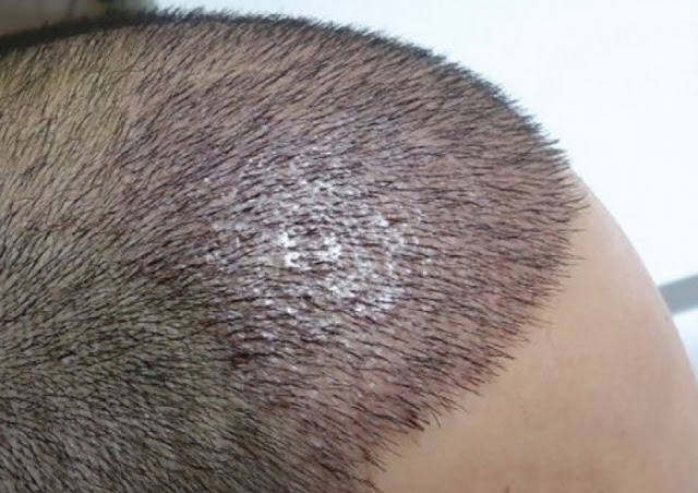 افضل مراكز زراعة الشعر في تركيا لعام 2019