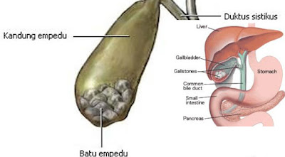 ciri-gejala-penyakit-batu-empedu