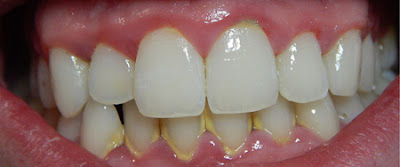 Viêm chân răng có mủ có hại thế nào?