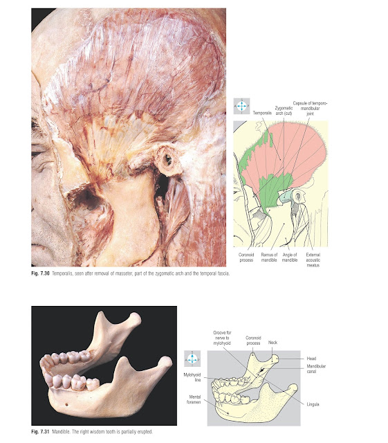 Temporalis, seen after removal of masseter, part of the zygomatic arch and the temporal fascia.