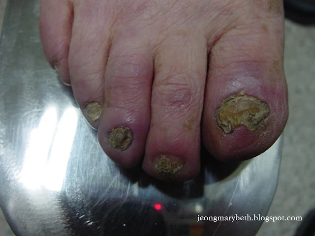 칸디다 손발톱진균증 이미지
