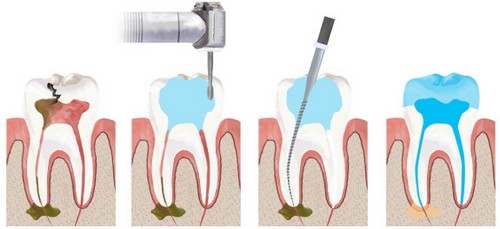 Cách điều trị viêm tủy răng an toàn và hiệu quả nhất - Nha Khoa Kim 2