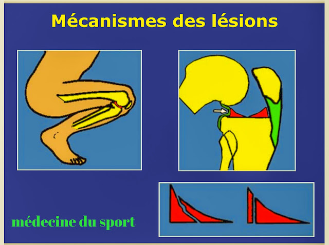 Pathologies des ménisques