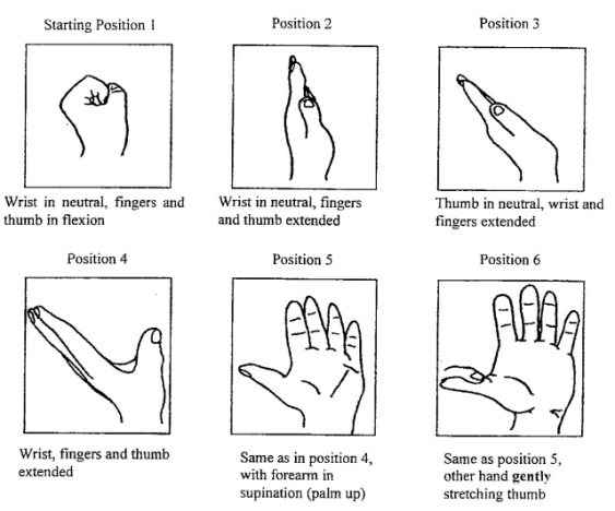 Tangan Anda Kebas? Anda Mungkin Menghidap Carpal Tunnel 