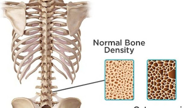 Anti-Osteoporosis And Fracture Healing