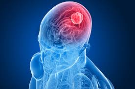 Urgent! symptoms and causes of brain tumors / cancer