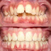 Điều chỉnh răng hô móm