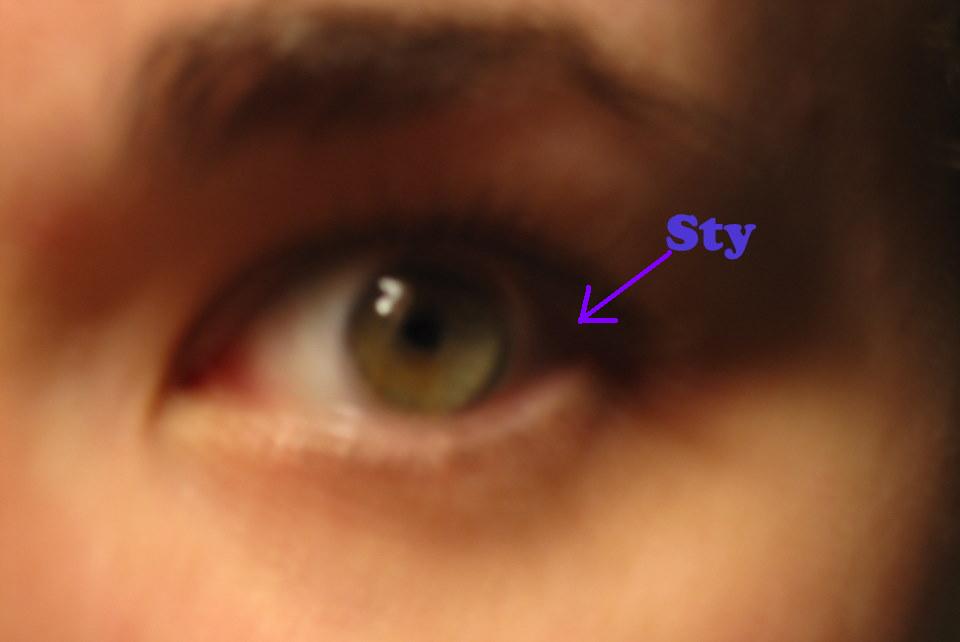 sty in eye. that sty and eye rhyme?