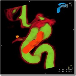 12 YRS POST CLIPPING RECURRENCE two color4_1