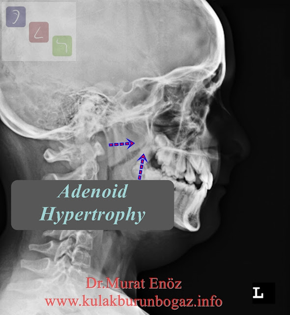 Adenoid Hypertrophy