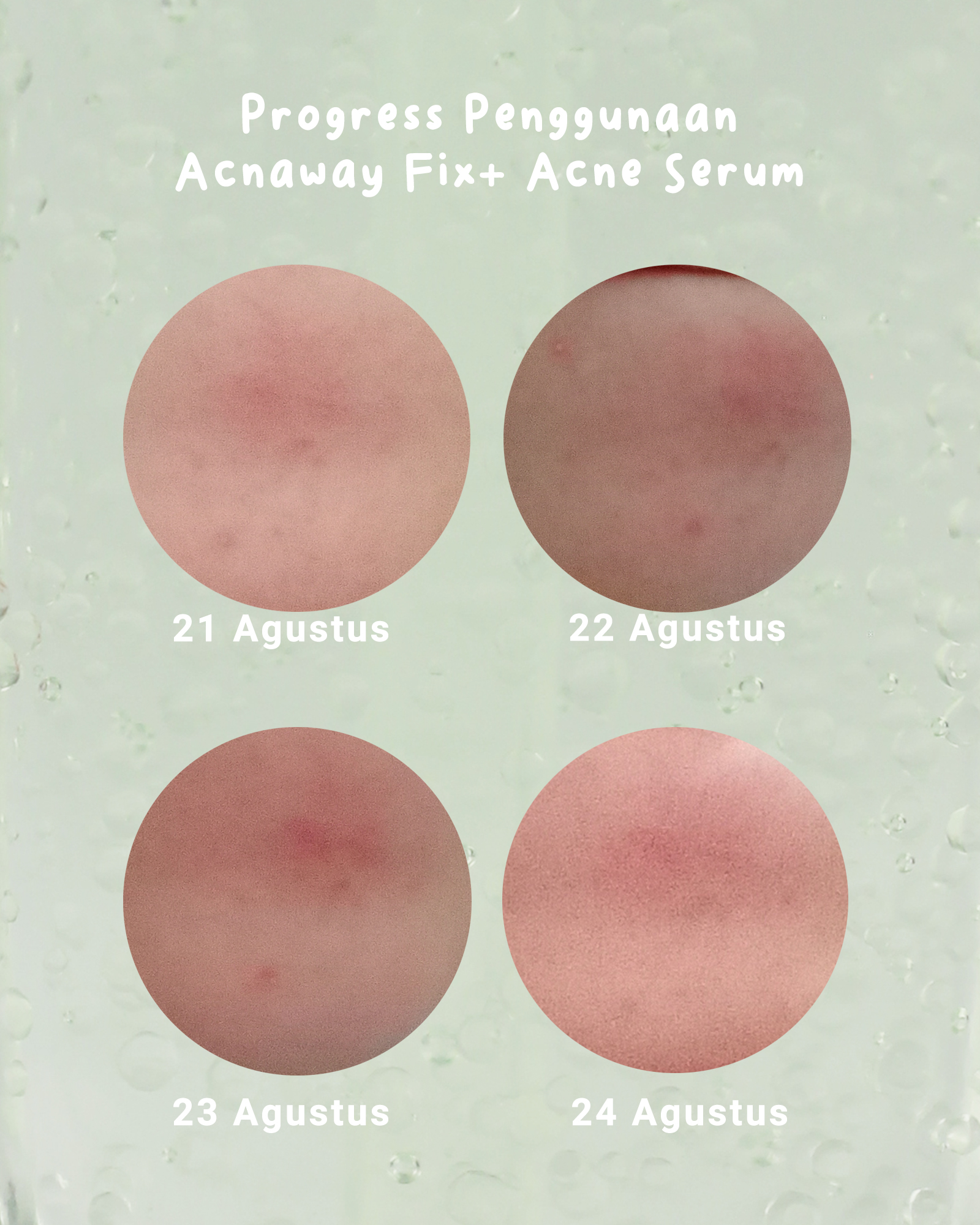 Acnaway Fix+ Acne Serum