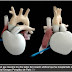 Murió 75 días después paciente a quien le trasplantaron el primer corazón artificial