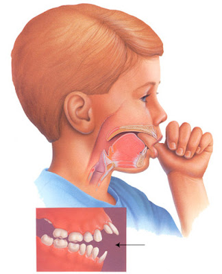 Cách khắc phục răng bị hô nhẹ như thế nào?