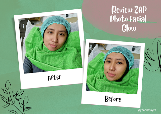 Pengalaman Treatment ZAP Photo Facial Glow di Pakuwon Mall Jogja